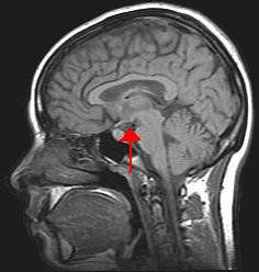 wikimedia / MRI brain.jpg/ https://commons.wikimedia.org/wiki/File:Hypothalamus.jpg / 2017-03-12 / PD Proteine